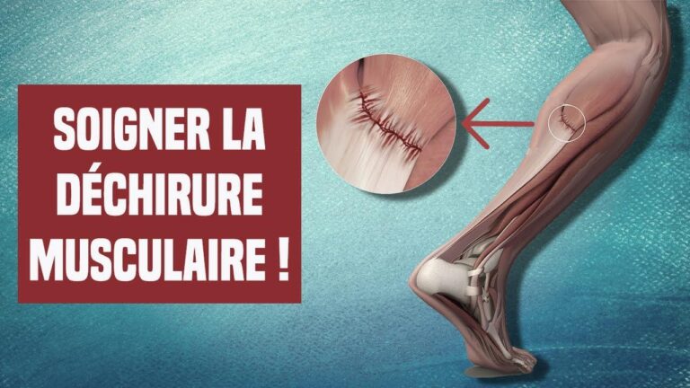 Comment guérir une déchirure musculaire : les étapes indispensables pour récupérer rapidement.