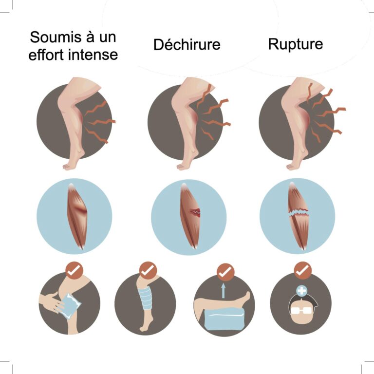 Comment soigner un claquage au mollet : conseils et astuces de prévention