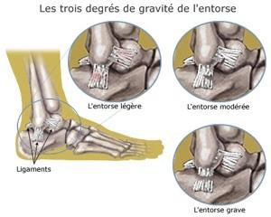 Comment Traiter un Arrachement Osseux de la Cheville Rapidement et Efficacement